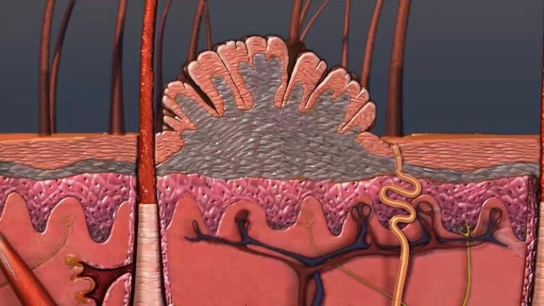 علائم زگیل تناسلی (HPV) و بهترین راه درمان آن