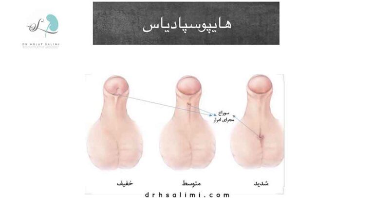 هيپوسپادياس چیست