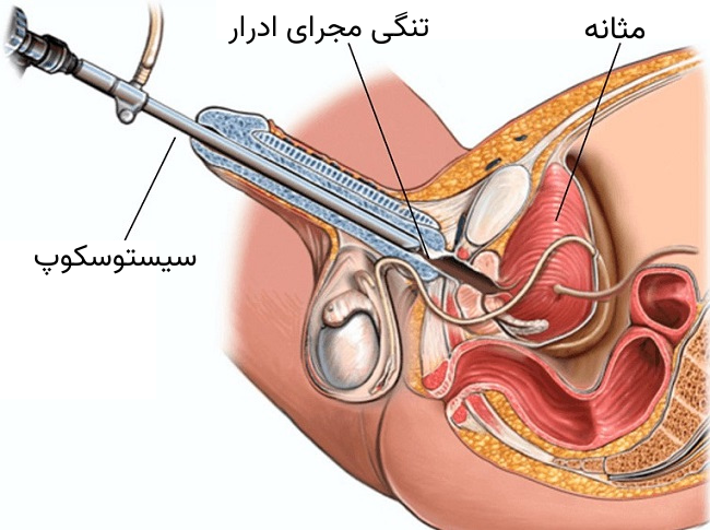 جراحی بسته تنگی مجرای ادرار (اورتروتومی با سیستوسکوپی)