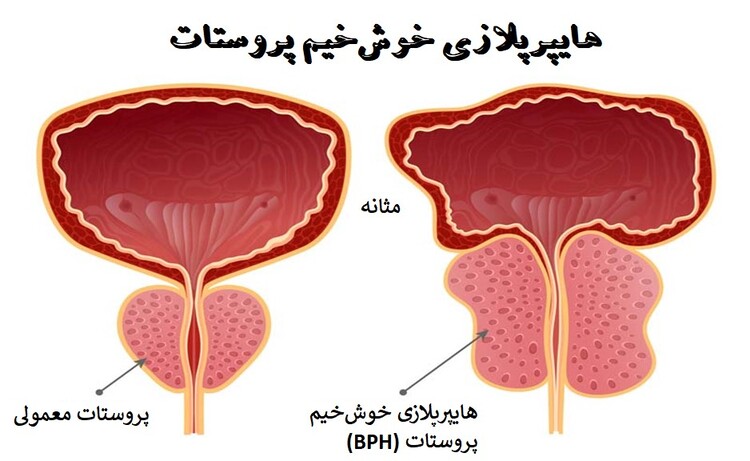 بزرگی خوش‌خیم پروستات (BPE)