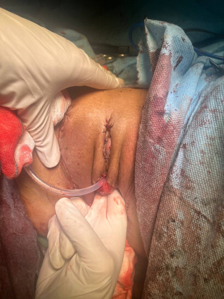 جراحى تطبیق جنسیت با استفاده از روده سیگموئید